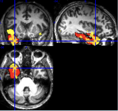 MRI scan with ROIs
